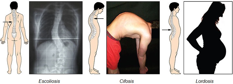 Desviación de la columna vertebral: escoliosis, cifosis y lordosis