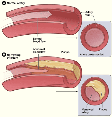 La aterosclerosis se produce por el depósito de placas de ateroma