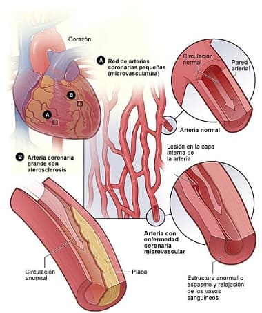 Enfermedades coronarias