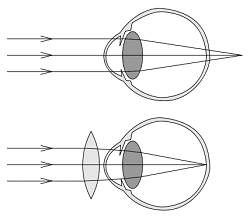 Hipermetropía y corrección con lente convergente