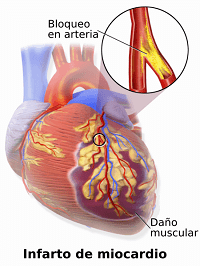 Cómo se produce un infarto agudo de miocardio