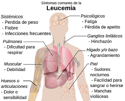 Principales síntomas de la leucemia