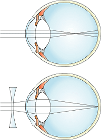 Miopía y su corrección con una lente divergente