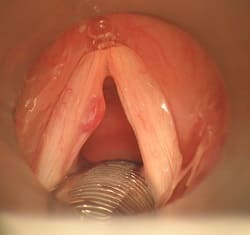 Nódulo en la cuerda vocal derecha
