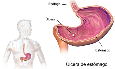 Ulcera gástrica