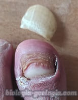 Uña caída de dedo gordo